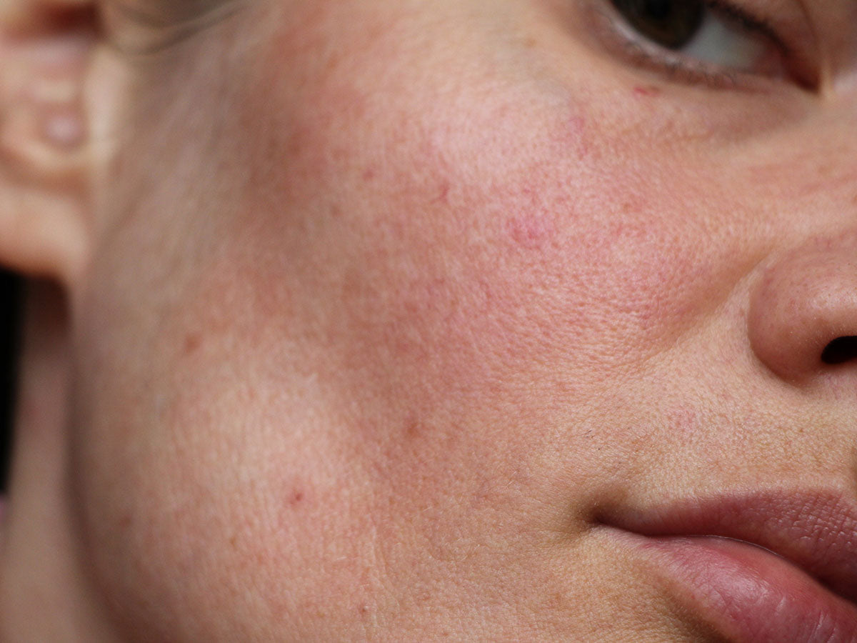 Sensitive Skin Emergency? Why Lotion P50T Should Be Your First Choice