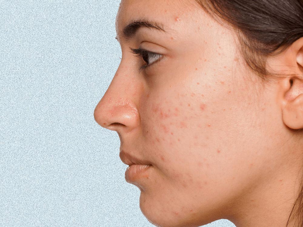 Woman side profile with blemished skin on grey background