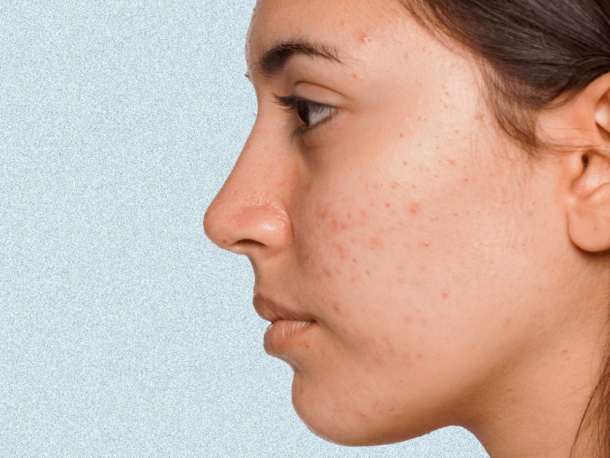 Acne Prone Skincare Solutions. Essential Tips To Keep Skin Clear, Healthy And Free Of Breakouts.