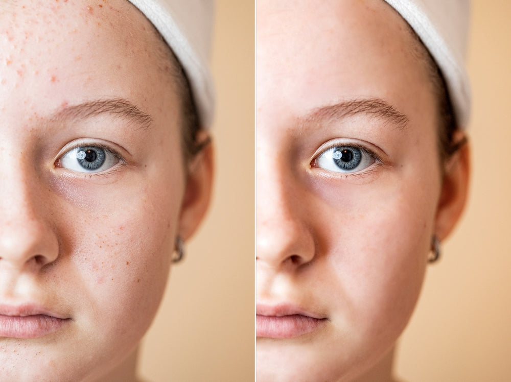 Teen Acne before & After